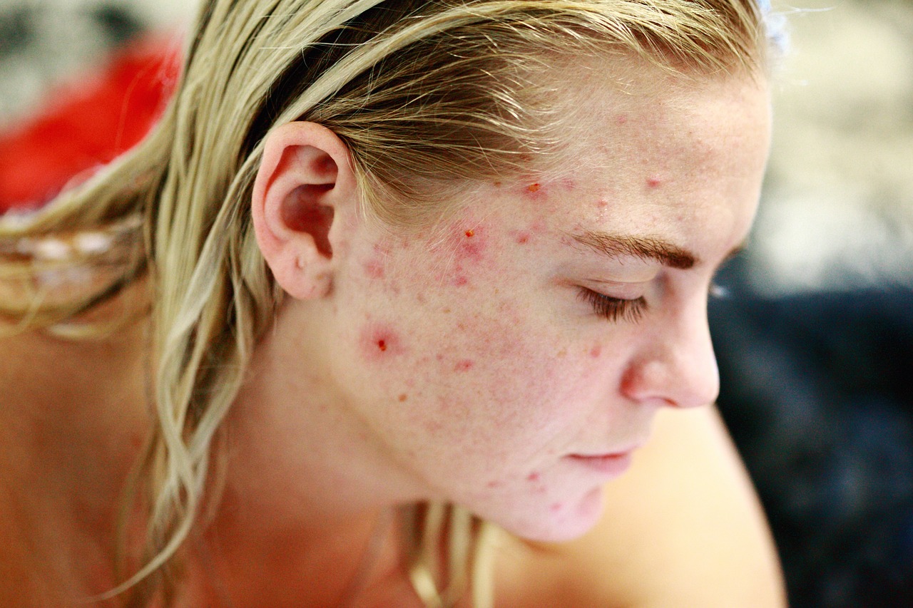 Pele sem Espinhas e macia mais rápido 5 acne, pele, espinhas, Pele sem Espinhas e macia