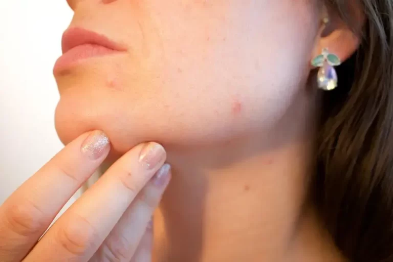 O que é Roacutan ? Como funciona o Tratamento com o Roacutan e os efeitos colaterais 1 Roacutan