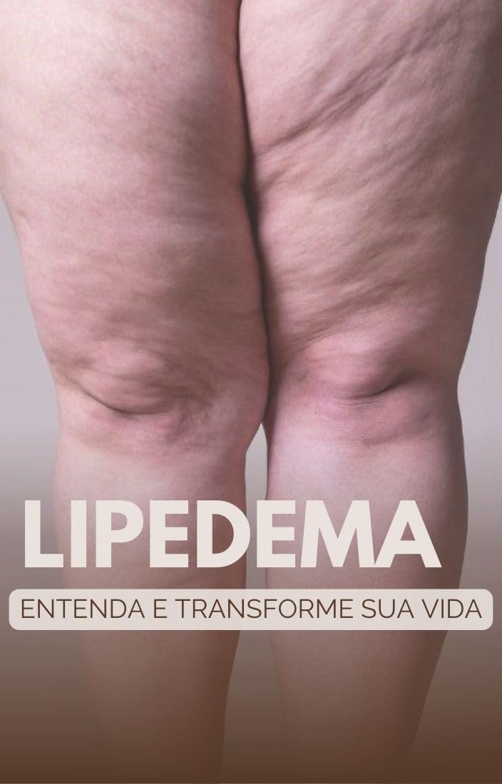 Lipedema - Entenda e transforme sua vida