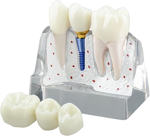 Ultrassist Modelo De Implante Dentário Para Educação Do Paciente, Implante Dentário 4 Vezes, Modelo De Coroa E Ponte Para Apresentação-Transparente
