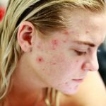 acne, pele, espinhas, Pele sem Espinhas e macia