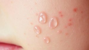 Bolhas Transparentes na Pele: Causas e Tratamentos Eficazes
