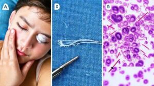 Remoção cirúrgica de verme da pálpebra: o que você precisa saber