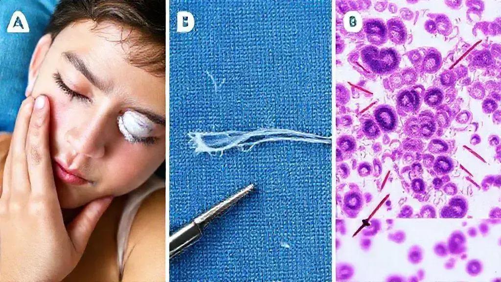 Remoção cirúrgica de verme da pálpebra: o que você precisa saber