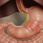 Entenda o refluxo biliar: causas, sintomas e tratamentos