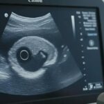 Cisto Anecoico: O que é e quais são os tipos mais comuns?