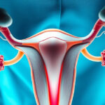 Cirurgia de endometriose: quando e como é indicada?